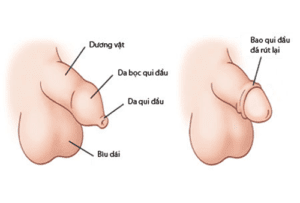 Bị hẹp bao quy đầu