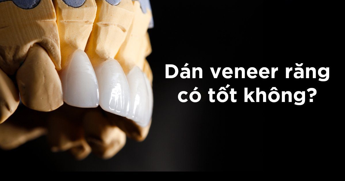 Dán veneer cho răng có tốt không? Có được lâu không?
